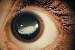 Типы и виды первичной глаукомы